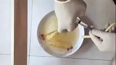 Reproduzir Introdução número 1 do cateter do sistema